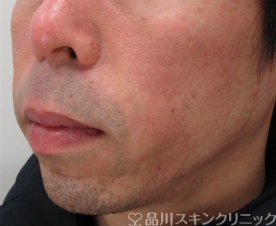 症例NO.33447のAFTER写真