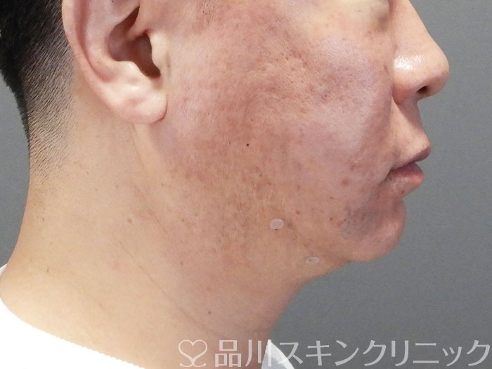 症例NO.73478のAFTER写真