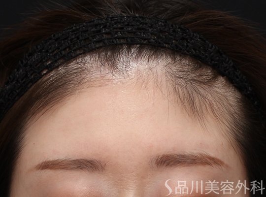 症例NO.73811のBEFORE写真