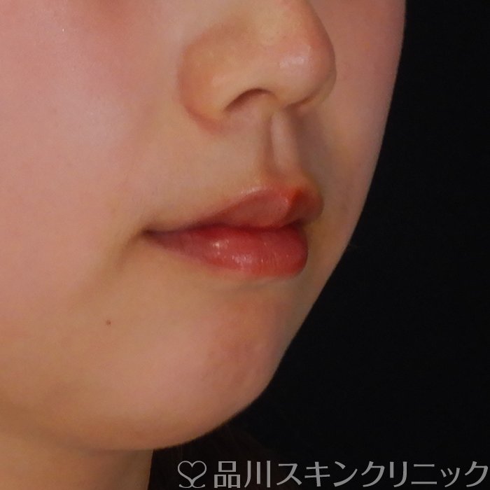 症例NO.69764のBEFORE写真