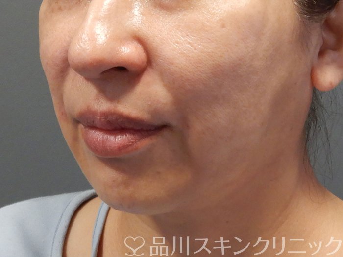 症例NO.70602のAFTER写真