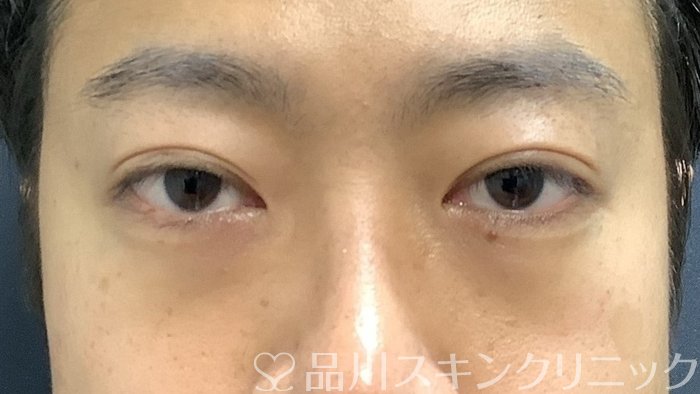 症例NO.64918のBEFORE写真