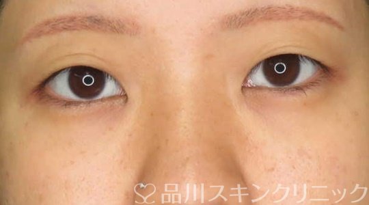 症例NO.70905のBEFORE写真