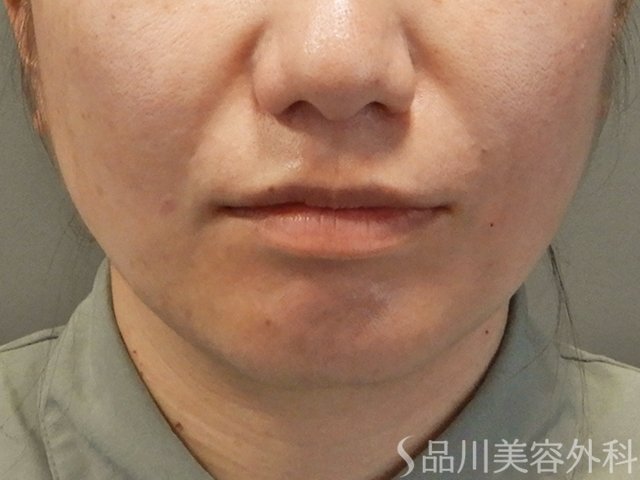 症例NO.73770のAFTER写真