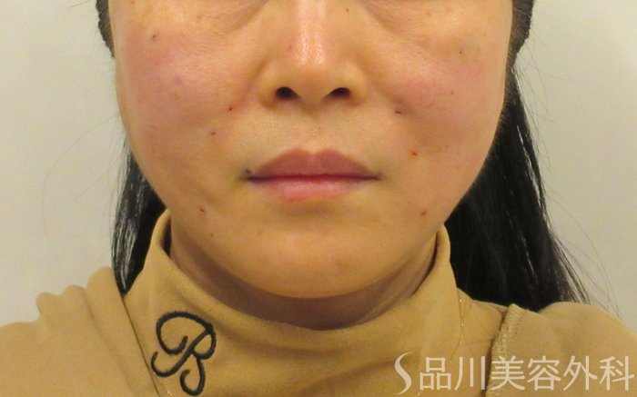 症例NO.73700のAFTER写真