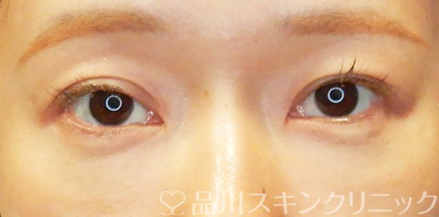 症例NO.67709のBEFORE写真