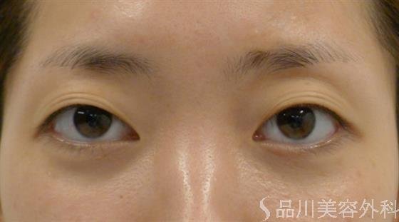 症例NO.38233のBEFORE写真