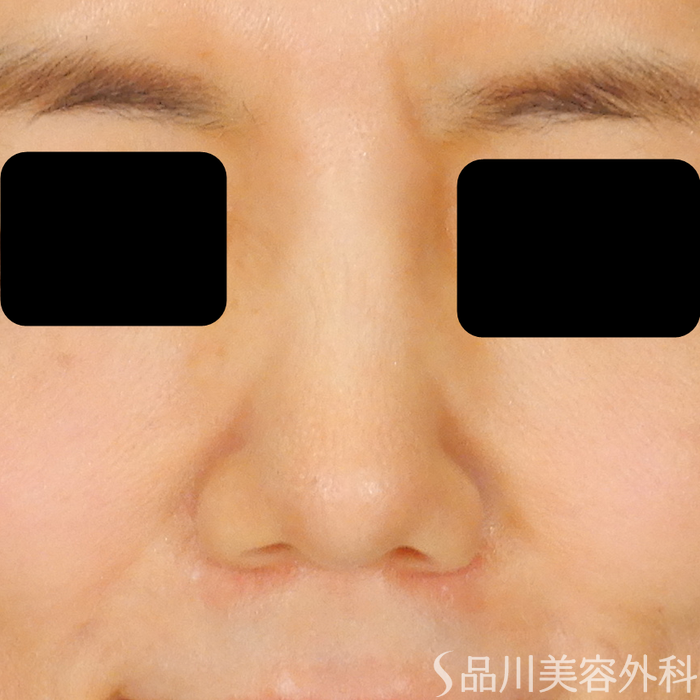 症例NO.67815のBEFORE写真