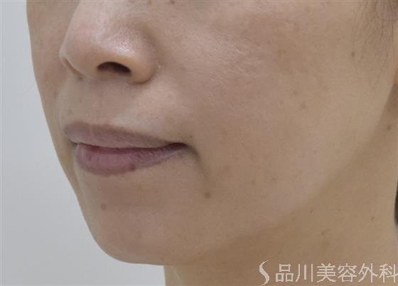 症例NO.50468のBEFORE写真
