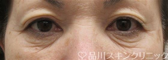 症例NO.60464のBEFORE写真