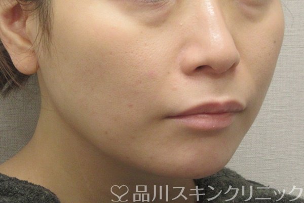 症例NO.72784のAFTER写真