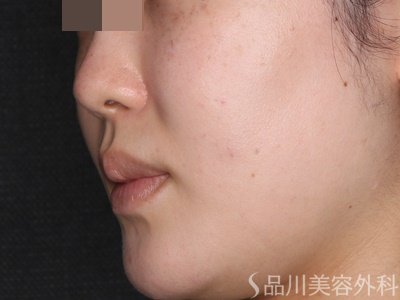 症例NO.74134のBEFORE写真