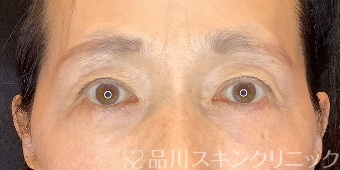 症例NO.71843のAFTER写真