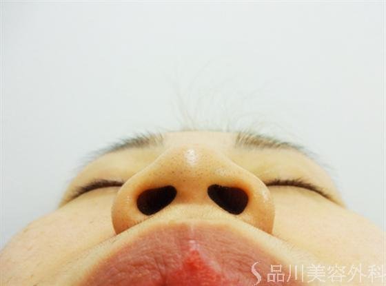 症例NO.16569のBEFORE写真