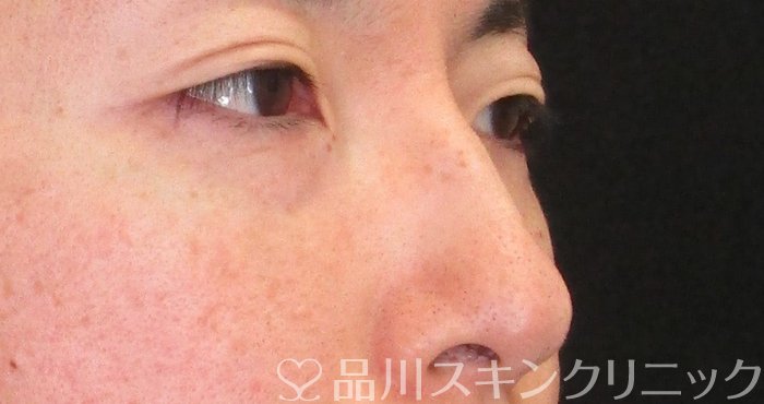 症例NO.74583のBEFORE写真