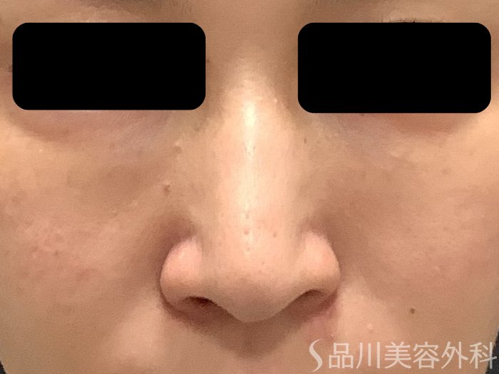 症例NO.75322のBEFORE写真
