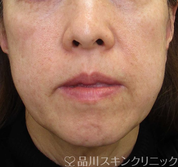 症例NO.65627のBEFORE写真