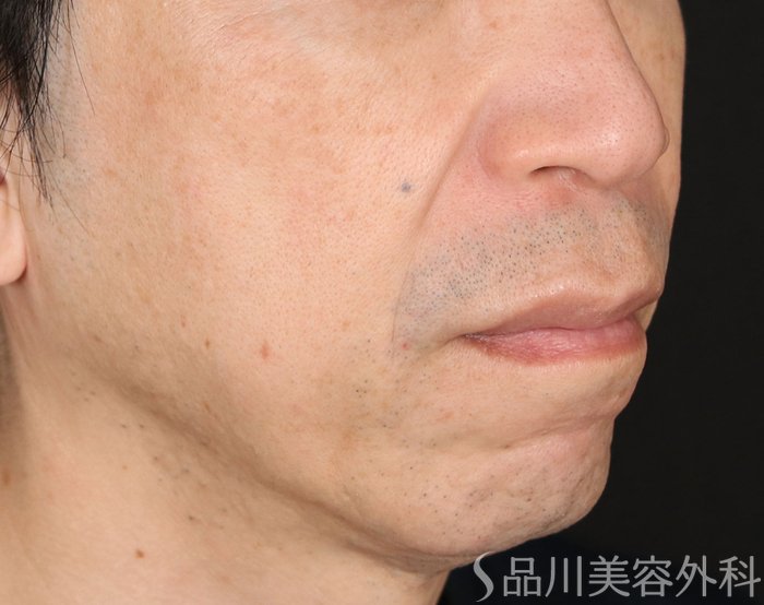 症例NO.71196のBEFORE写真
