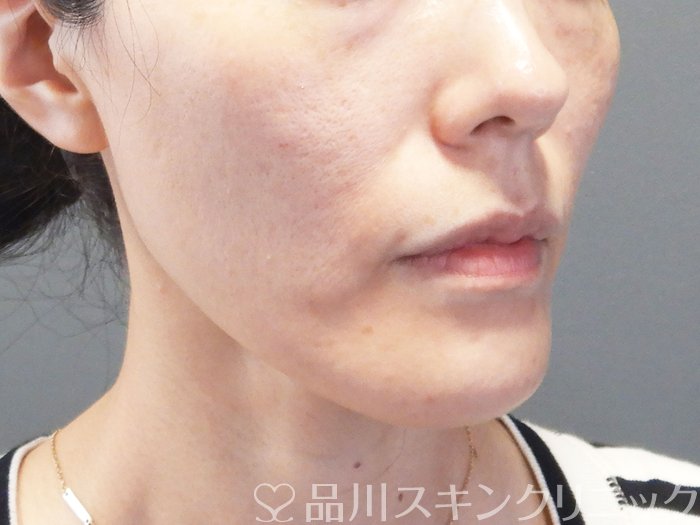 症例NO.75242のBEFORE写真