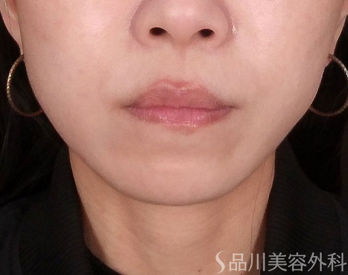 症例NO.69800のAFTER写真