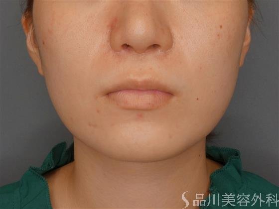 症例NO.61804のBEFORE写真