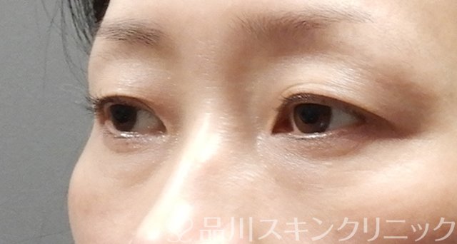 症例NO.63639のBEFORE写真