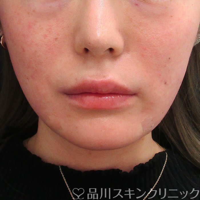 症例NO.73496のAFTER写真