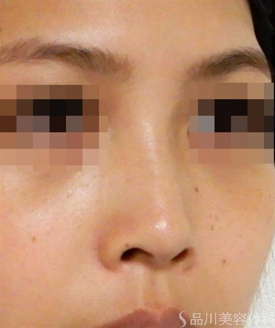 症例NO.38169のAFTER写真