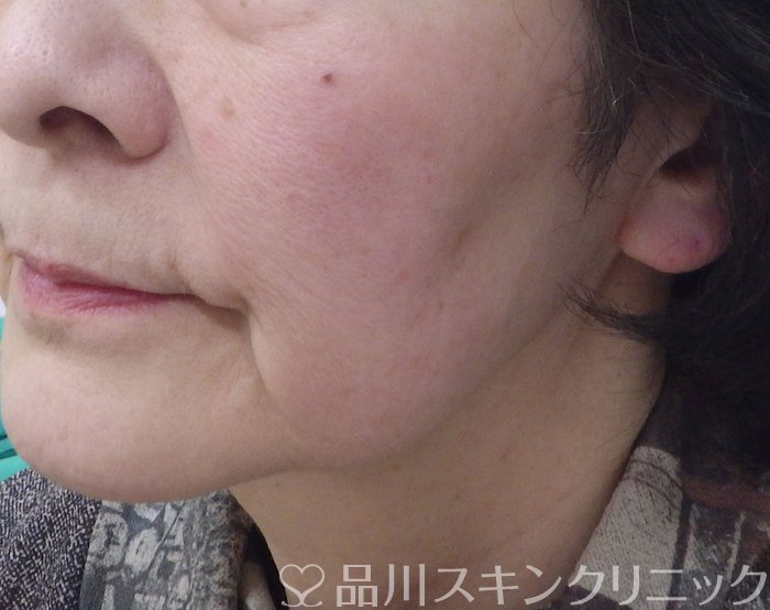 症例NO.69343のBEFORE写真