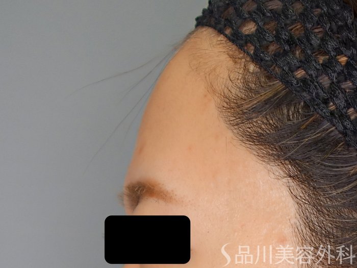 症例NO.70360のBEFORE写真