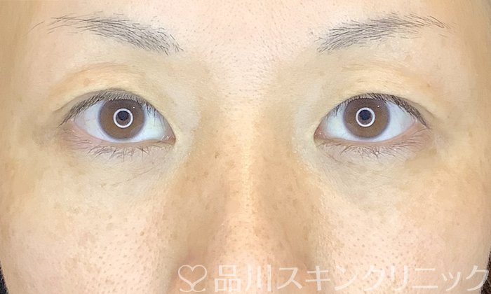 症例NO.70379のAFTER写真