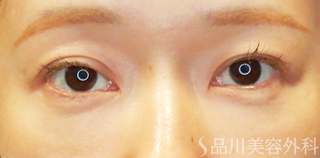 症例NO.67709のBEFORE写真