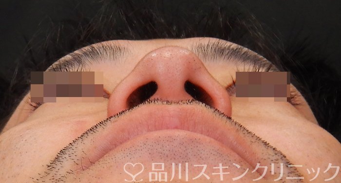 症例NO.64641のBEFORE写真