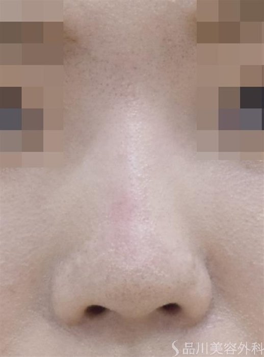 症例NO.52913のAFTER写真