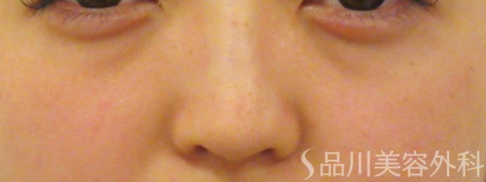 症例NO.70628のAFTER写真