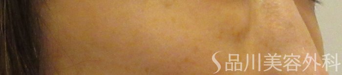 症例NO.72100のBEFORE写真