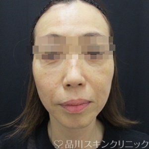 症例NO.71869のAFTER写真