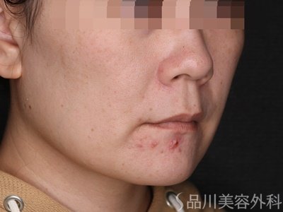 症例NO.70385のBEFORE写真