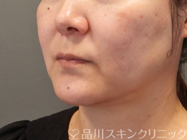 症例NO.75317のBEFORE写真