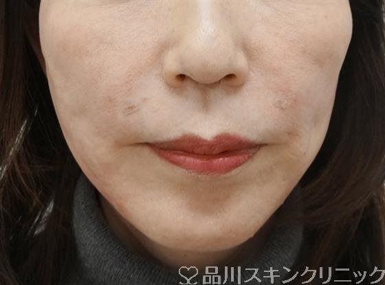 症例NO.41140のAFTER写真