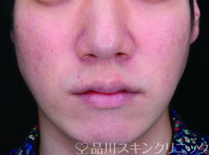 症例NO.71285のAFTER写真