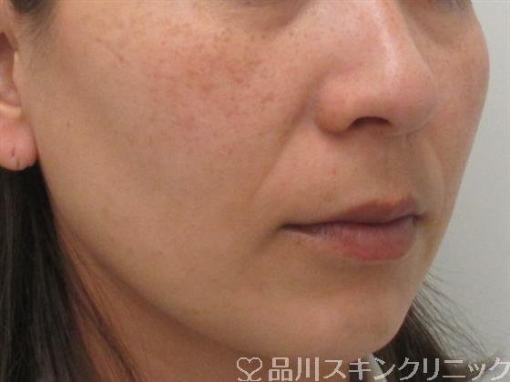 症例NO.26761のBEFORE写真
