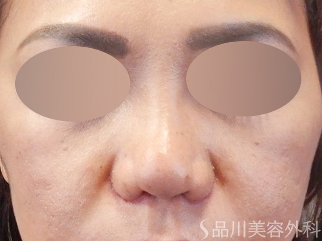 症例NO.67917のAFTER写真