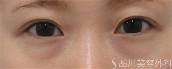 症例NO.26661のBEFORE写真