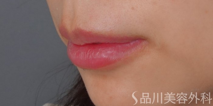 症例NO.72259のAFTER写真