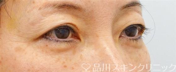 症例NO.48294のBEFORE写真