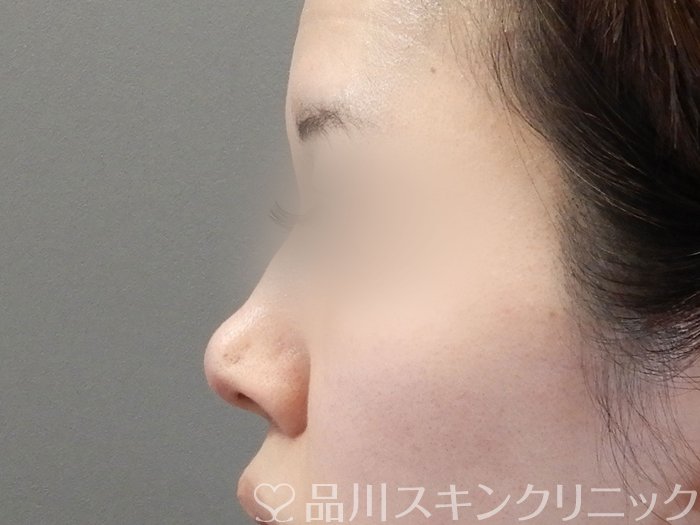 症例NO.65320のAFTER写真