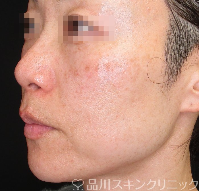 症例NO.74699のBEFORE写真