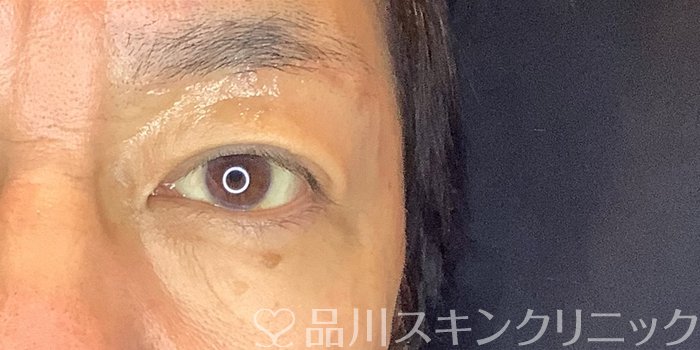 症例NO.67641のAFTER写真