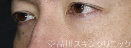 症例NO.65104のBEFORE写真